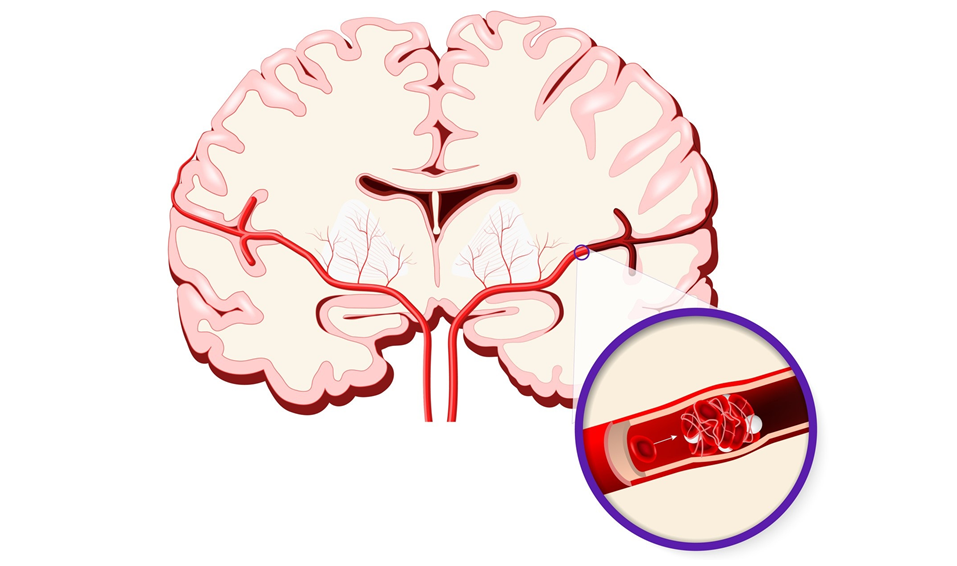 Ursache für einen Schlaganfall kann auch ein Gefäßverschluss sein